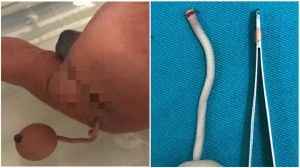 brazilian-baby-born-with-a-tail