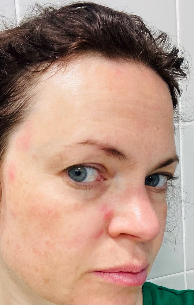 For decades, Emma Elms dismissed her condition as rosacea, but after multiple visits to her GP, blood tests and dermatologist appointments, she finally got a diagnosis