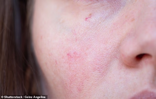 Dr Philippa Kaye says it is possible that a red mark on the face that refuses to go away could cancer